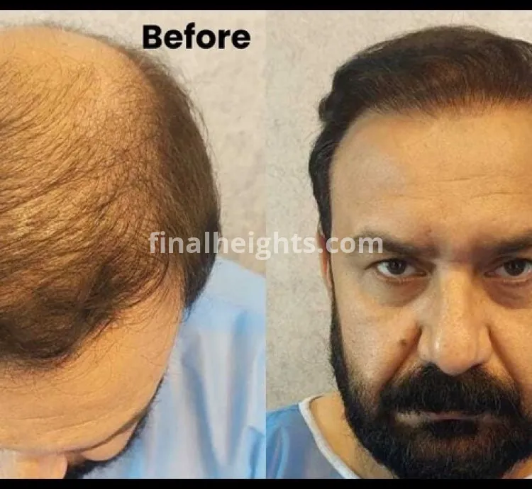 ILHT Hair Transplant Pakistan