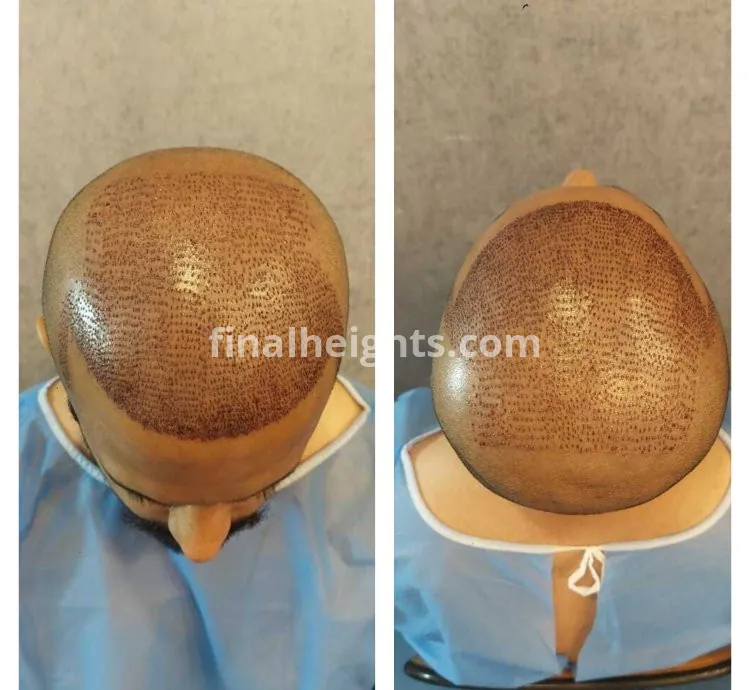 ILHT Hair Transplant Pakistan