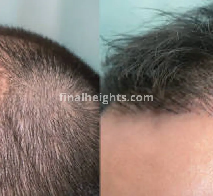 Hair Transplant in Islamabad