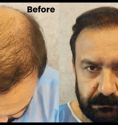 ILHT Hair Transplant Pakistan