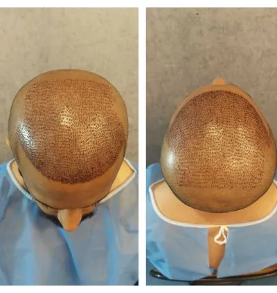 ILHT Hair Transplant Pakistan 3