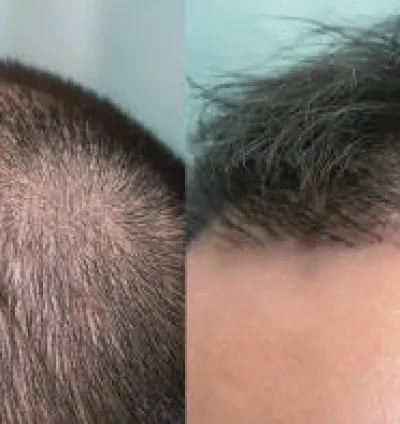 Hair Transplant in Islamabad